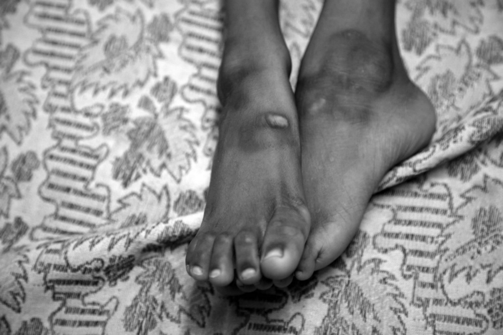 Chingari rehabilitation center 17